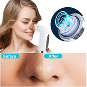 Blackhead Remover